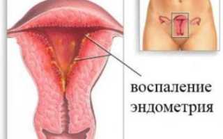 Все о эдометрите