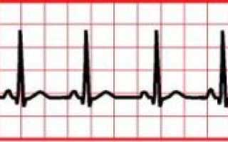 Синусовая брадиаритмия сердца