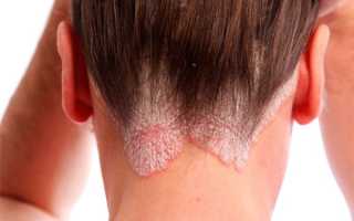 Как принимать фолиевую кислоту при псориазе?