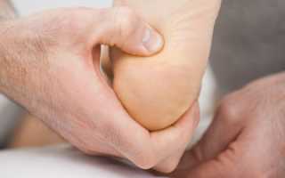 Как лечить пяточную шпору Димексидом?