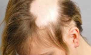 Все о очаговой алопеции