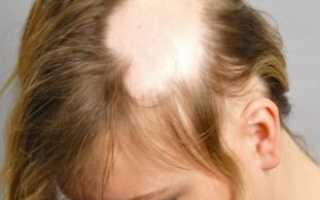Все о очаговой алопеции