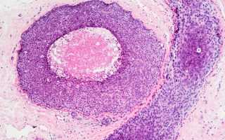 Карцинома ин ситу — развитие и описание болезни