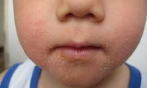 Признаки авитаминоза на коже