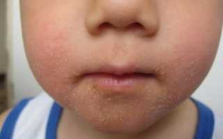 Признаки авитаминоза на коже