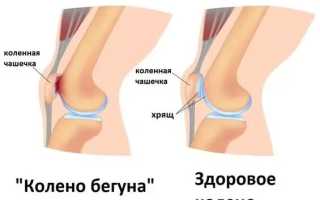 Почему болит коленная чашечка?