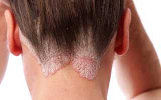 Энтеросгель при псориазе