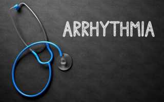 Аритмия синусовая