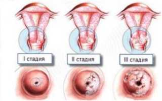 Дисплазия шейки матки 2 степени