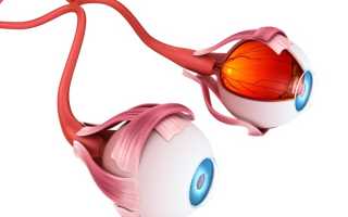 Глиома зрительного нерва