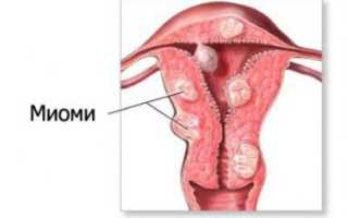 Все о миоме матки