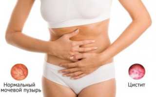 Можно ли пить Флемоксин при цистите?