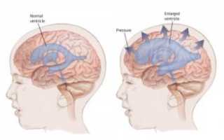 Гидроцефалия