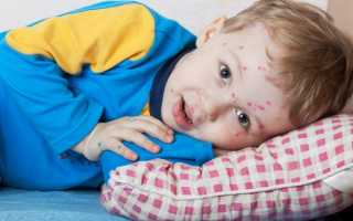 Можно ли Супрастин при ветрянке?