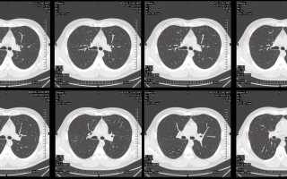 Томография органов грудной клетки