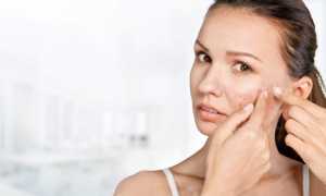 Можно ли избавиться от прыщей с помощью Активированного угля?