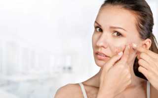 Можно ли избавиться от прыщей с помощью Активированного угля?