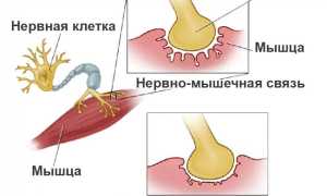 Миастения