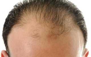 Подробно об андрогенетической форме алопеции