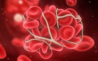 Все о тромбофилии