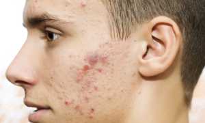 Помогает ли Прополис от прыщей?