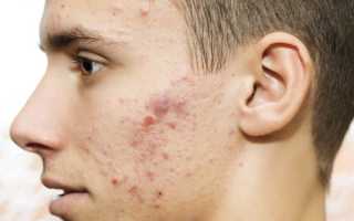 Помогает ли Прополис от прыщей?