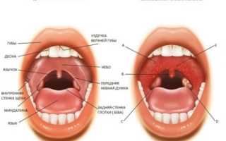Как принимать Амоксиклав при ангине?