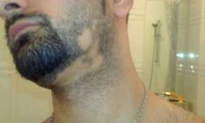 Подробно об алопеции бороды