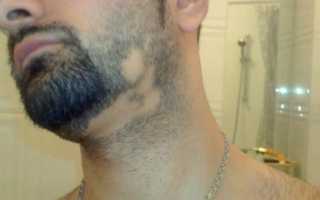 Подробно об алопеции бороды