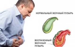 Холецистит