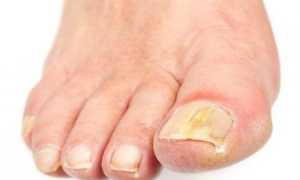 Как лечить грибок на большом пальце ноги?