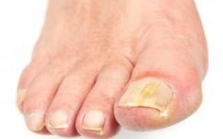 Как лечить грибок на большом пальце ноги?
