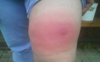 Отек после укуса осы