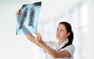 Признаки отека легкого