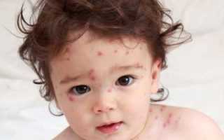 Все что нужно знать о ветрянке у ребенка
