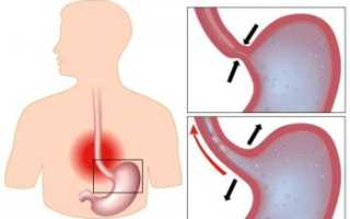 Все о эзофагите