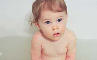 Купание ребенка при ветрянке