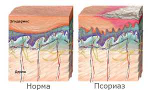 Все о псориазе