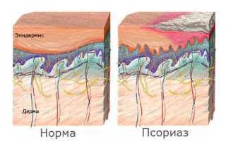 Все о псориазе