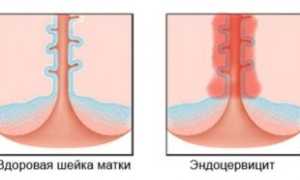 Все о эндоцервиците