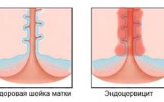 Все о эндоцервиците