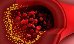 Как принимать настойку Прополиса от холестерина?