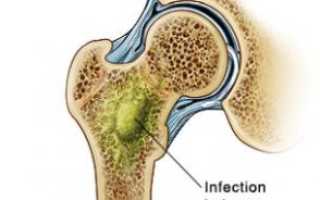 Остеомиелит