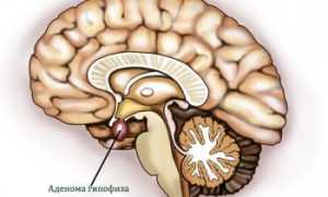 Аденома гипофиза