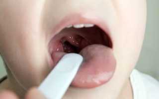 Золотистый стафилококк в горле