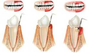 Пародонтит