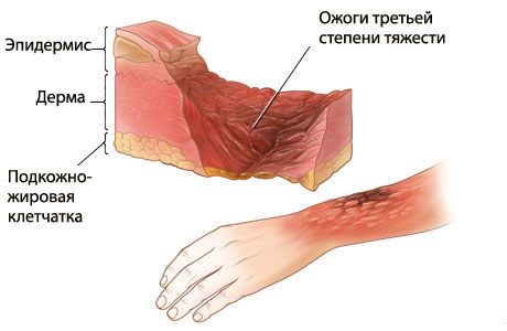 Ожоги их причины признаки виды