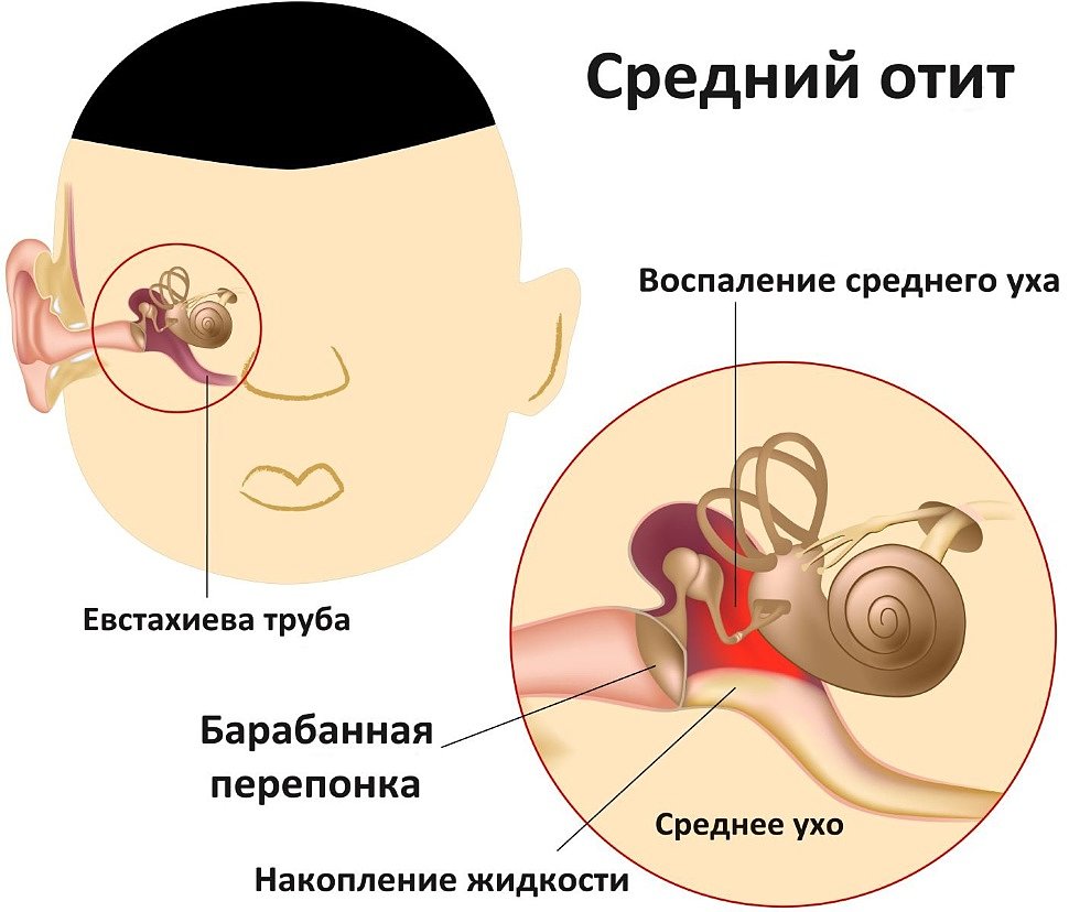 Отит при аденоидах у детей