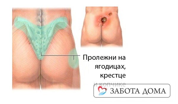 Пролежни на ягодицах