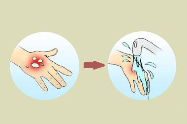 Первая помощь при радиационных ожогах